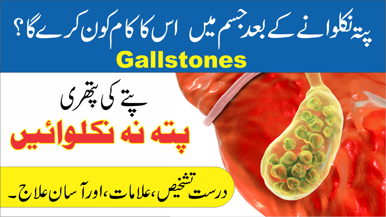 Gallstones || پتہ نہ کلوائیں پتے کی پتھری کا علاج