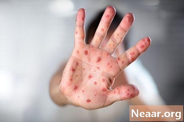 ہاتھ اور پاٶں کی تشخیصی علامات