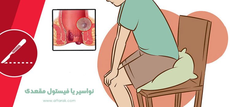 بھگندر یا نواسیر