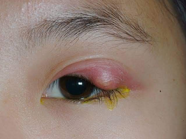 Eye stye