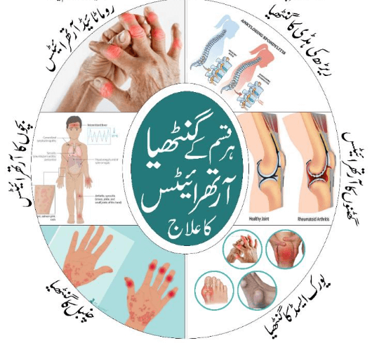 آرتھرائیٹس
